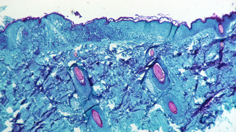 世衛：猴痘疫情與猴子沒有關聯 應停止傷害猴子