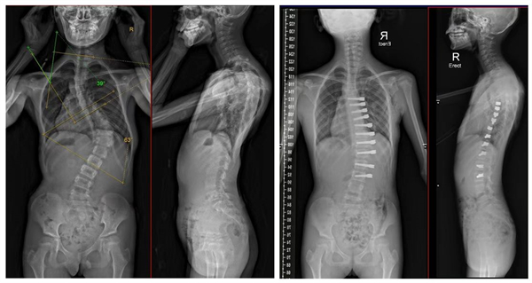圖4:左為術前全脊柱正側位X線片,主彎Cobb角63°。右為術後全脊柱正側位X線片,側彎角度明顯減小,且隨着生長發育,側彎會進一步改善。.jpg