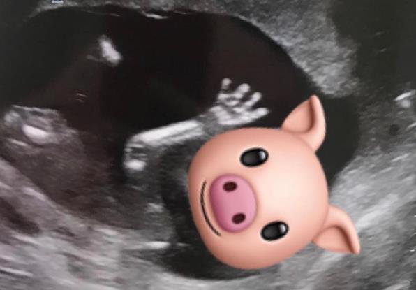 胡杏儿晒B超照片宣布怀上二胎:猪宝宝终于加入