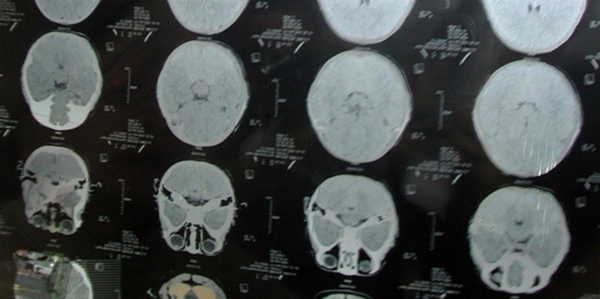 研究發現台灣人特有的腦中風突變基因