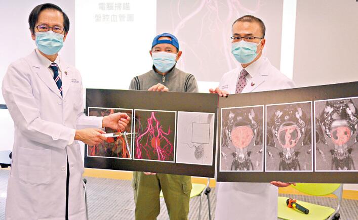 中大研究指「前列線動脈栓塞術」成效可預測 助選合適治療方案