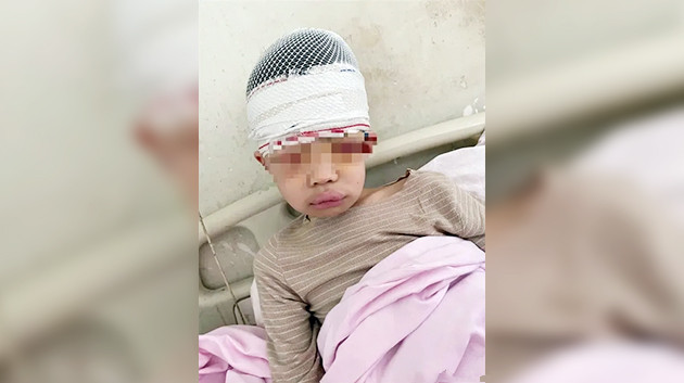 豫一男童被體罰致頭皮骨分離 警方通報：傷情為輕傷 教師被刑拘