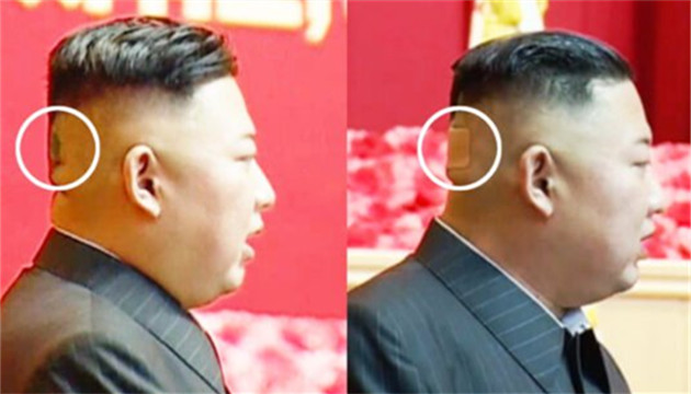 外媒：金正恩頭貼神秘膏藥 健康狀況引猜測