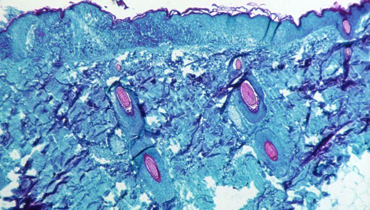 全球確診37宗猴痘病例 世衛召開緊急專家會議