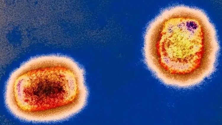 台灣地區現首宗猴痘確診個案