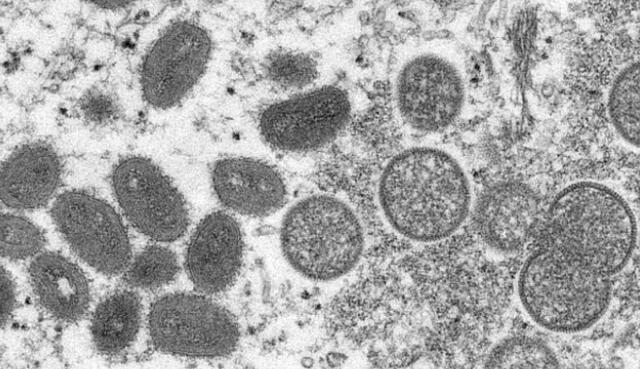 澳首席醫療官：猴痘成澳洲全國性傳染病事件