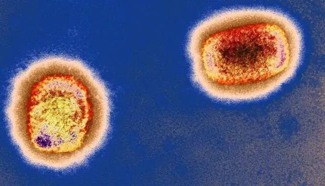 美國猴痘病例超1.7萬例 美媒稱美政府正重蹈覆轍