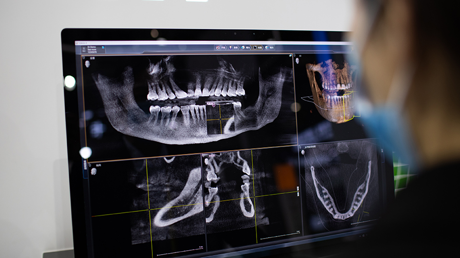 廣東大部分地區4月20日起單顆種植牙總費用降至7000元左右