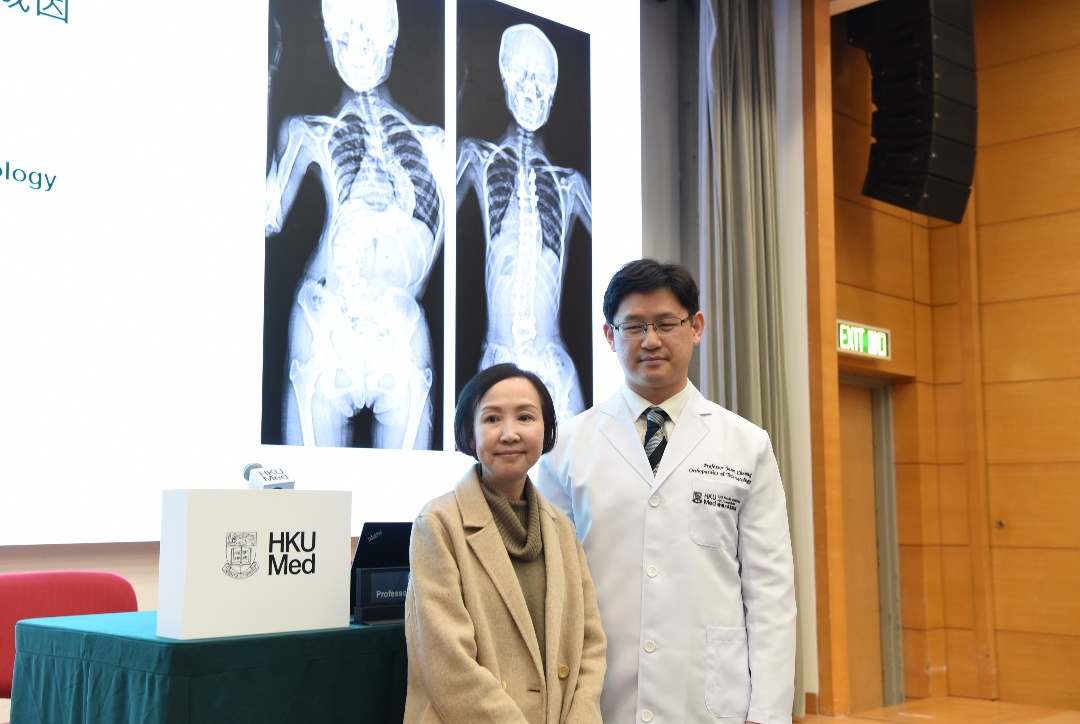 港大就原發性脊柱側彎取得全球突破  主因為SLC6A9基因變異