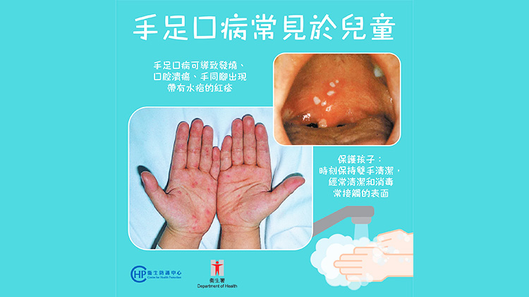 過去3天院舍/學校爆發5宗手足口病個案 衞生防護中心籲家長多留意幼童情況