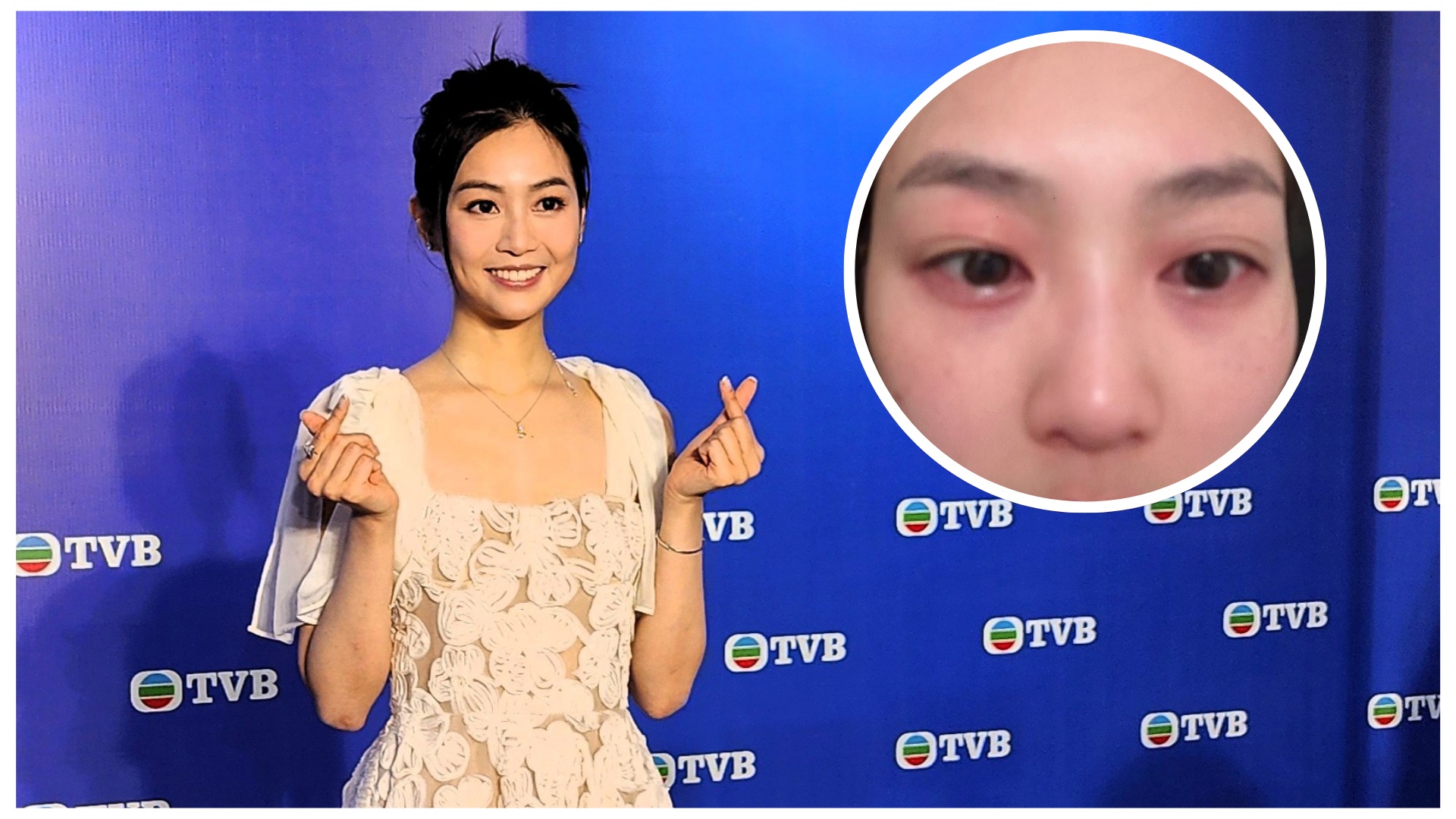 有片 | 【娛樂】郭柏妍回應食物敏感引致眼腫呼吸困難緊急入院：當時有想過死亡