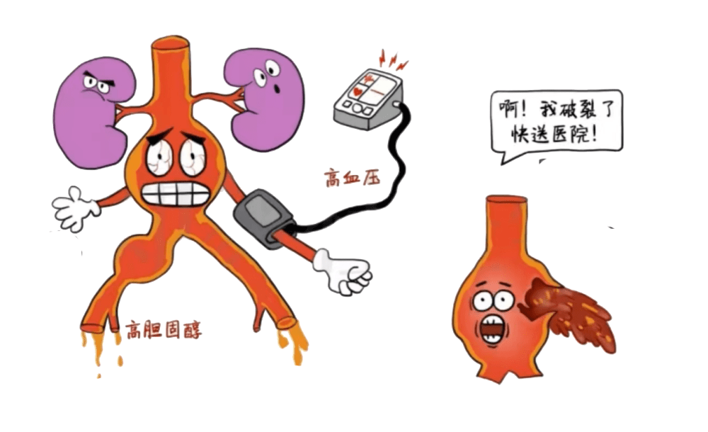 雜交手術室里的「拆彈戰」！ 深圳二院血管外科搶救腹主動脈瘤破裂患者