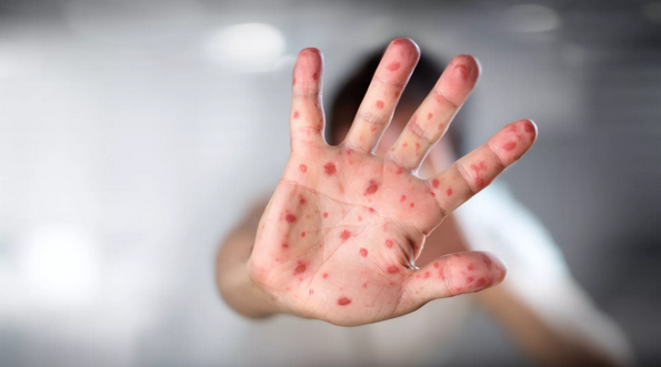 媒體：西澳大利亞州出現自1997年以來最大規模的麻疹疫情